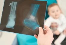 ۵۰ شکستگی عمدی در بدن یک نوزاد ۲ ماهه