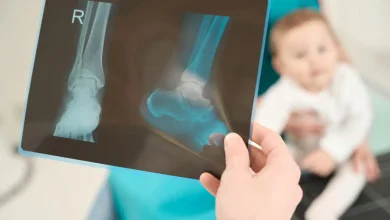 ۵۰ شکستگی عمدی در بدن یک نوزاد ۲ ماهه