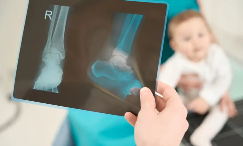 ۵۰ شکستگی عمدی در بدن یک نوزاد ۲ ماهه